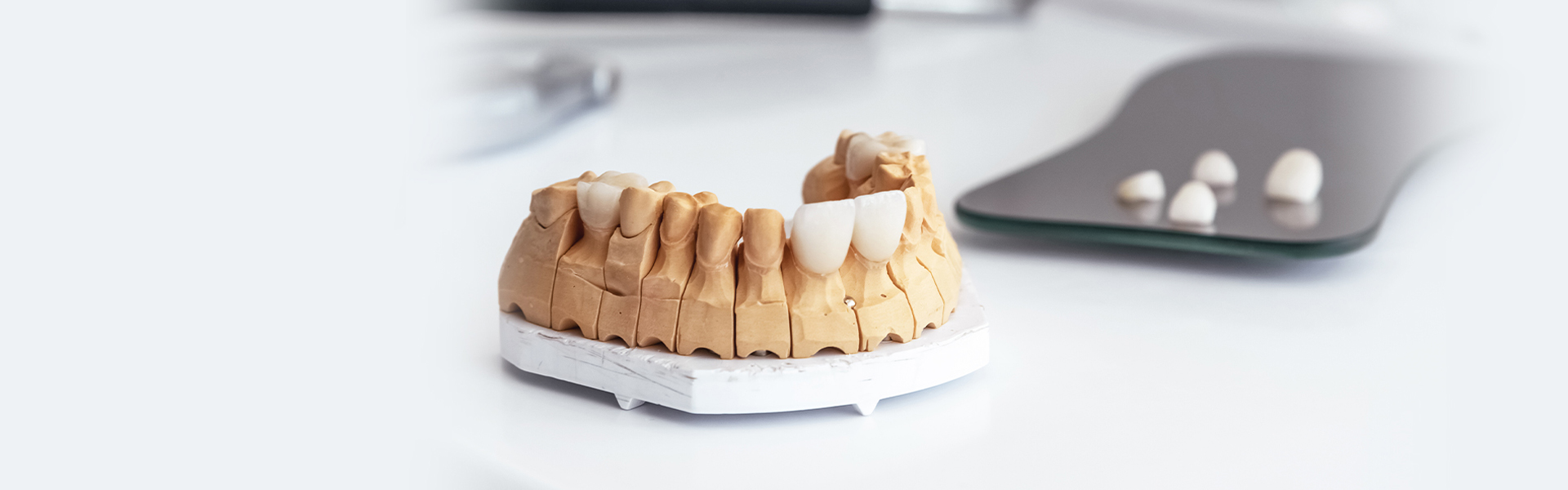 Lumineers vs. Veneers: Which Is Right for You?