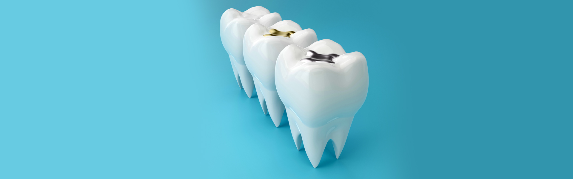 What are Dental Fillings, and Why Are They Necessary?