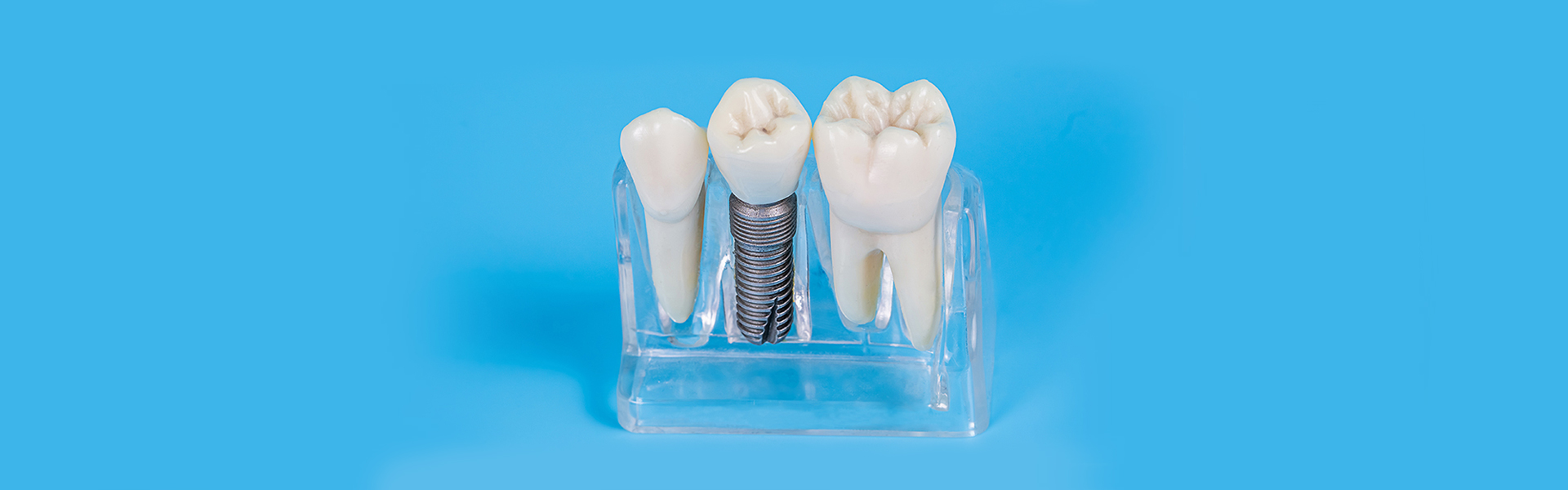 5 Facts About Dental Implant Recovery Process