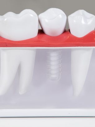 Why Choose Dental Implants in Roseville, CA