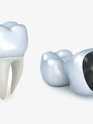 How Dental Crowns Improve Nutrition and Eating Comfort in Older Adults